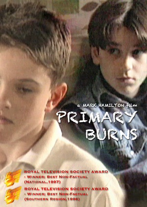 Primary Burns